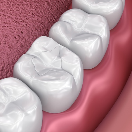 Animated smile with metal free dental restoration