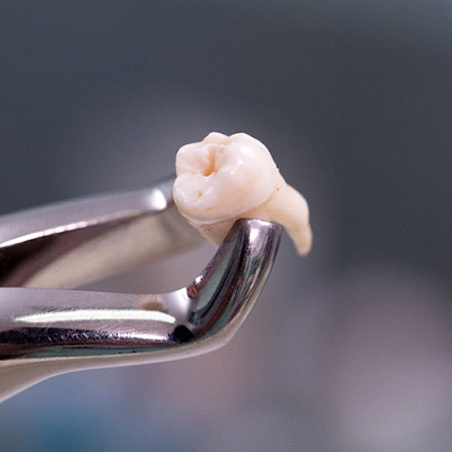An extracted tooth in Wylie