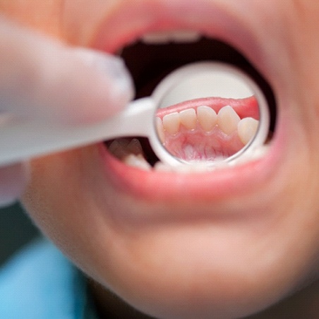 Backside of child’s teeth in Wylie