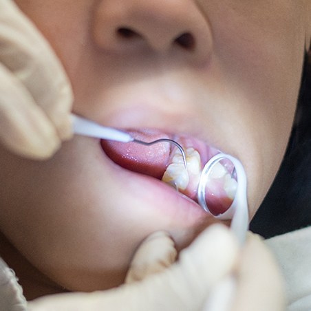 Young patient receiving metal-free restoration