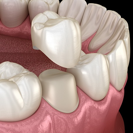 Animated smile during metal free dental crown placement