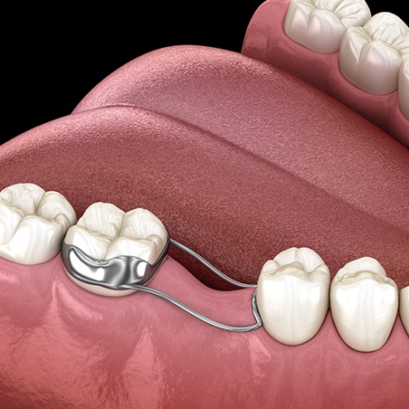 Animated smile with space maintainer appliance in place