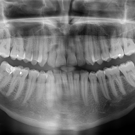 Panoramic dental x-rays