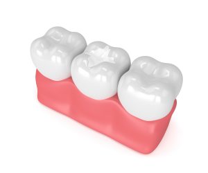 Dental sealant on molar