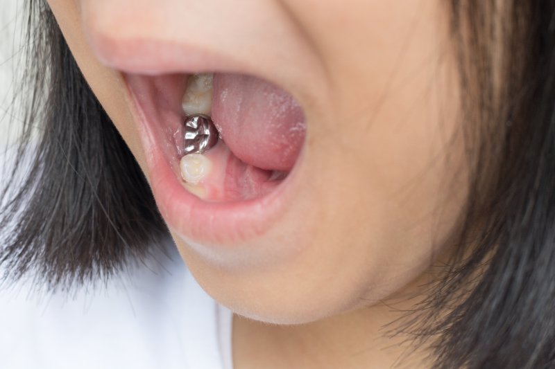 young girl with a metal dental crown