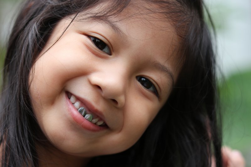 A girl smiling with two metal dental crowns