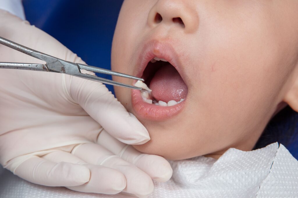 Closeup of child's baby tooth being extracted
